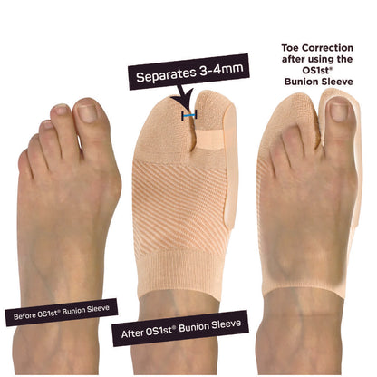 Bunion Bracing Sleeve (HV3) - Natural